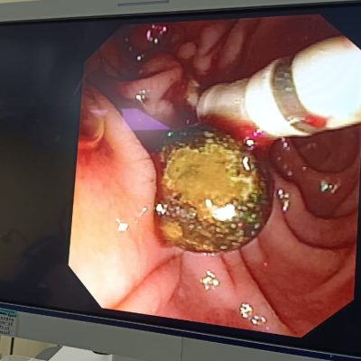 ERCP (Endoscopic Retrograde Cholangiopancreatography)
