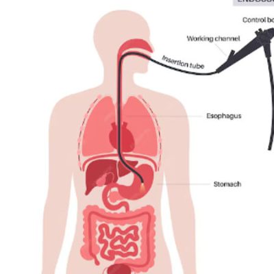 Endoscopic Ultrasound (EUS) Diagnostic and Fine-Needle Aspiration (FNAC)